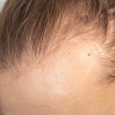  soluzione a capelli diradati, alopecia e stempiatura fisiologica